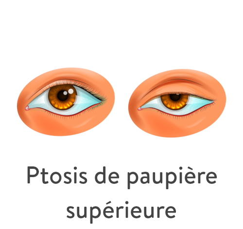 Ptosis